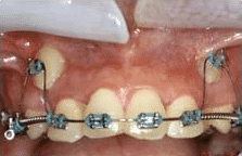 Close-up of upper teeth with orthodontic braces and wires attached to both teeth and gums, showing dental correction in progress.