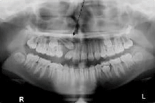 Panoramic dental X-ray showing upper and lower teeth, jawbone, and roots, with right (R) and left (L) sides labeled.