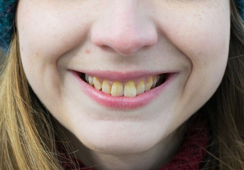 Close-up of a person smiling, showing yellowed teeth and light skin, with part of their lower face and mouth visible.