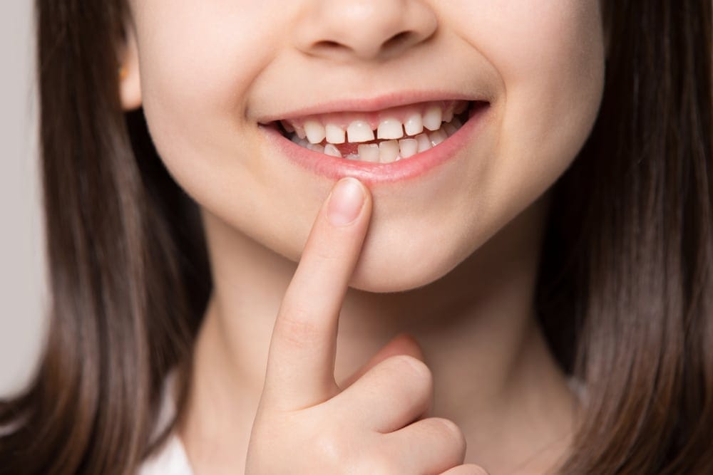 Close-up of a child smiling and pointing at a gap in her teeth where a tooth has fallen out.