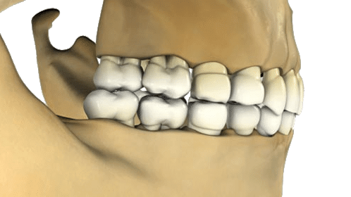 Digital rendering of a human skull focusing on the side view of upper and lower teeth aligned in a closed bite position.