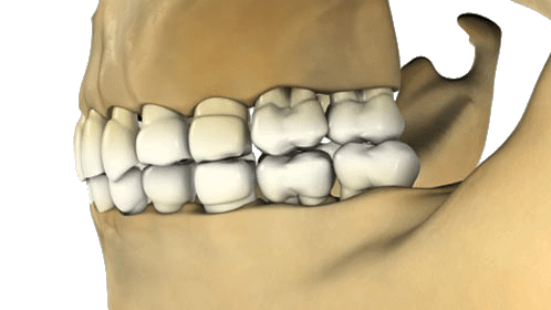 3D rendering of a human jaw showing upper and lower teeth in alignment with part of the jawbone visible.