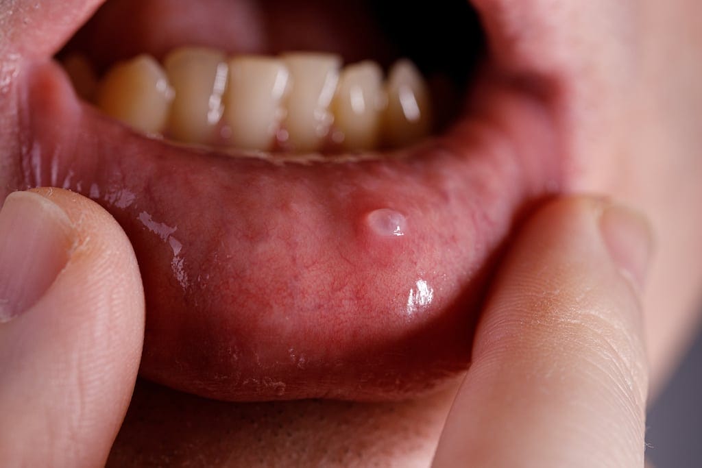 A close-up of a person's lower lip being pulled down to reveal a small, round, white ulcer or sore on the inner lip lining.
