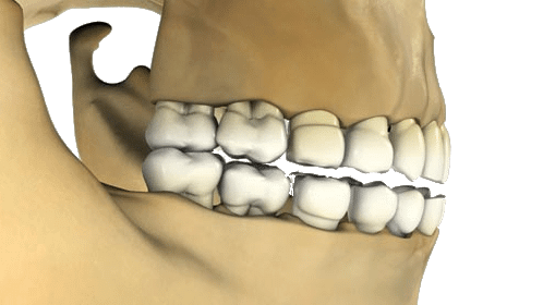3D rendering of a human skull showing side view of upper and lower jaw with teeth aligned in a closed bite.
