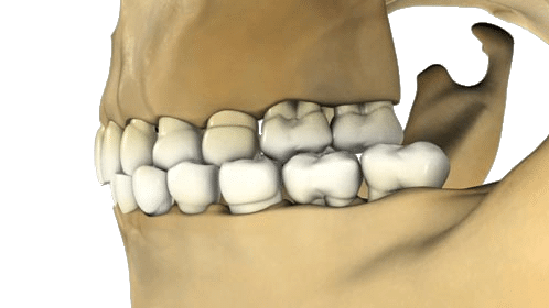 3D rendering of a human skull showing side view of upper and lower teeth in alignment.