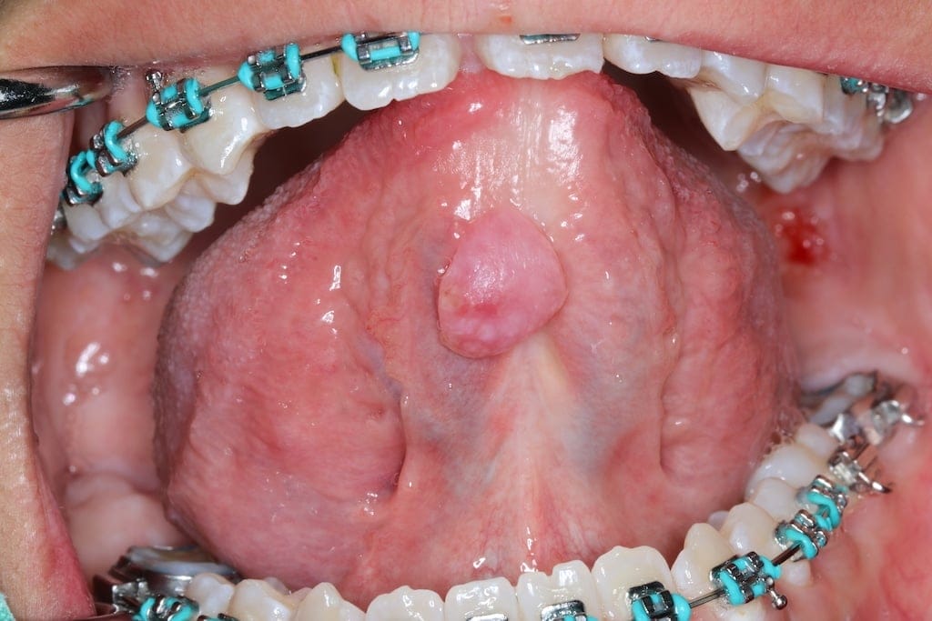 Close-up of an open mouth showing upper and lower teeth with braces and a raised, round lesion on the underside of the tongue.